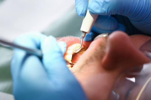 Best Emergency Wisdom Tooth Extraction in Liolnton, NC