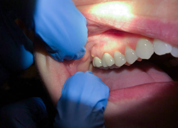 Best Walk-In Emergency Dental Services in Liolnton, NC